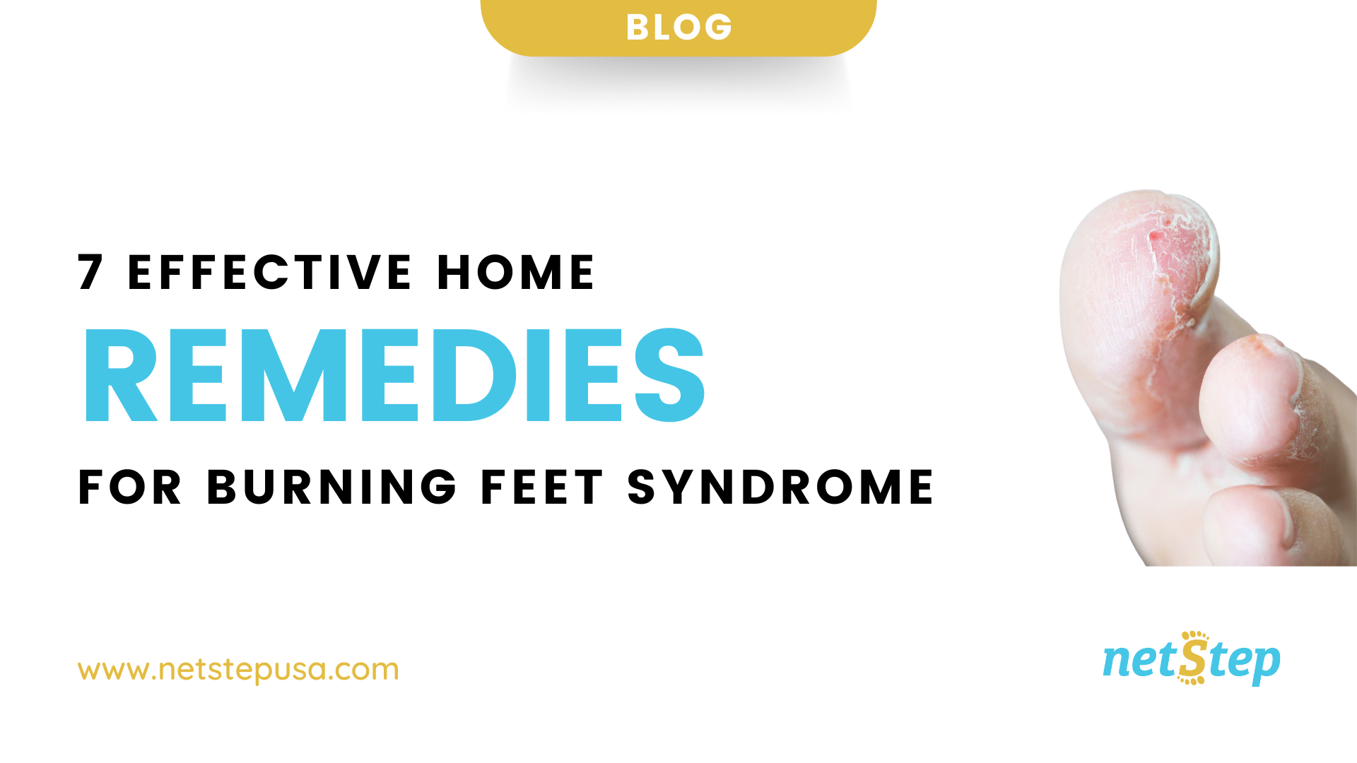 7 Effective Home Remedies for Burning Feet Syndrome