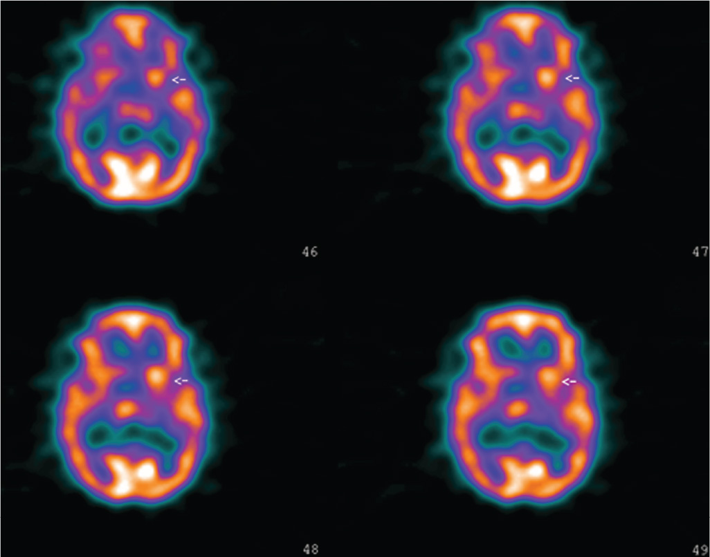 Sydenham Chorea and Other Choreas Neupsy Key