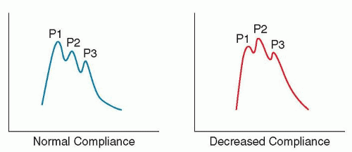 Intracranial Pressure and Neurocritical Care Monitoring Neupsy Key