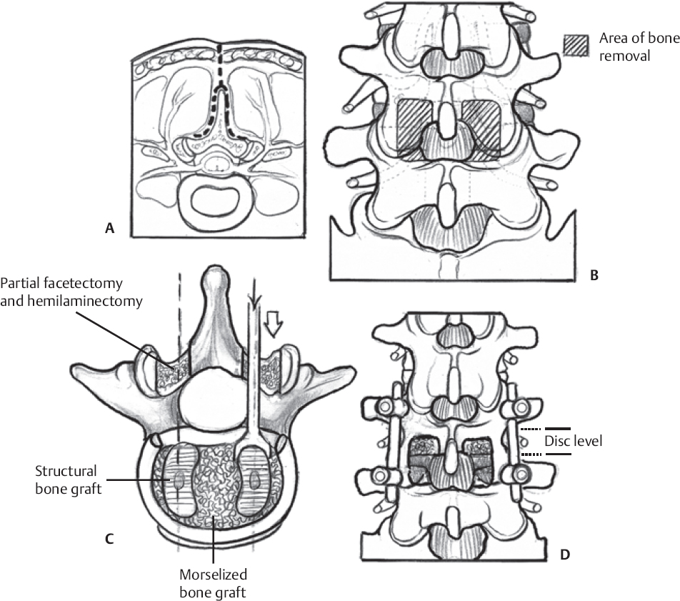 List 93+ Pictures Lumbar Spinal Fusion Surgery Pictures Updated