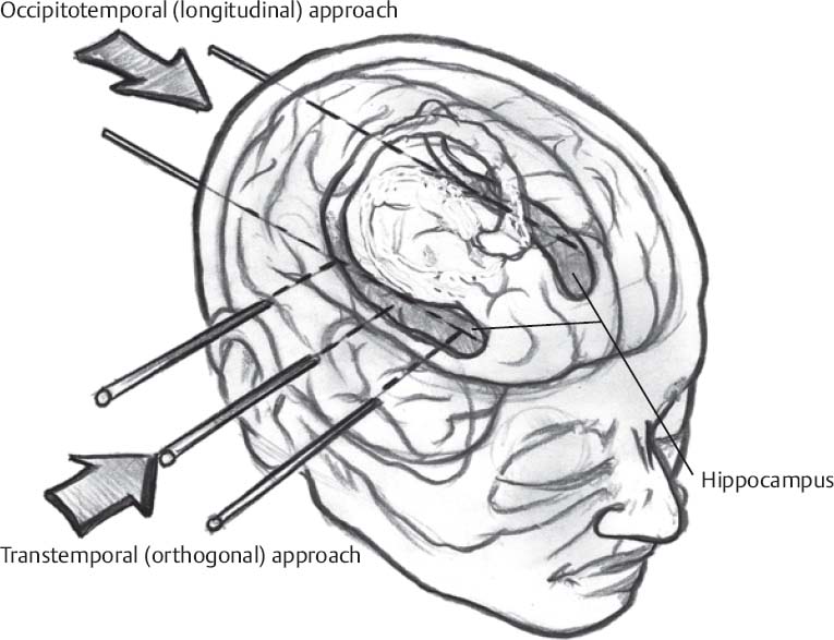 Stereotactic Placement of Temporal Depth Electrodes Neupsy Key