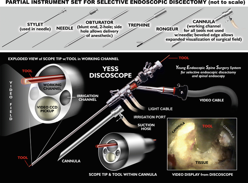 Endoscopic Foraminal Approach to the Lumbar Spine Neupsy Key