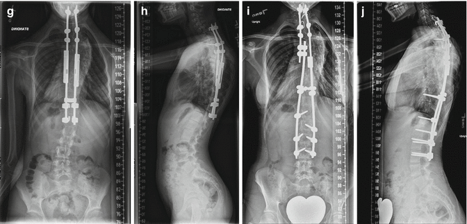 Neurofibromatosis Neupsy Key