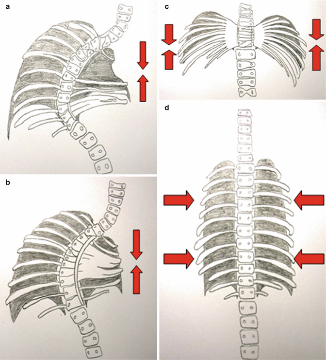 VEPTR Expansion Thoracoplasty Neupsy Key