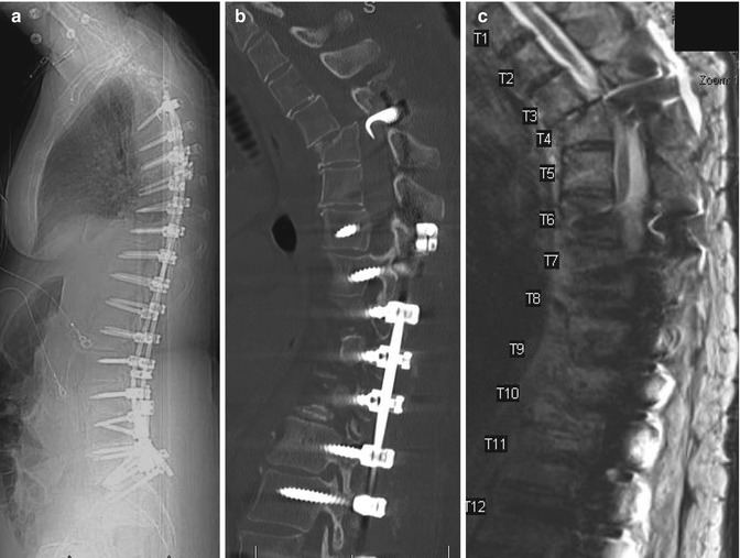 Proximal and Distal Junctional Fixation Techniques Neupsy Key