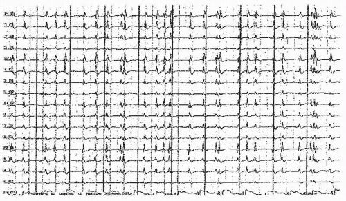 Alpha Coma Eeg Pattern - chartdevelopment
