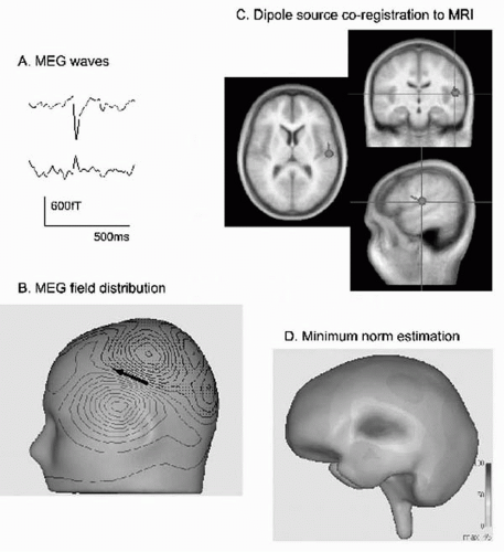 Localization and Field Determination in Electroencephalography and ...