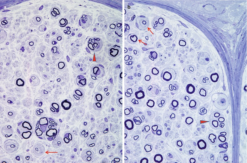 Neuropathy Associated with Endocrine and Metabolic Disease Neupsy Key
