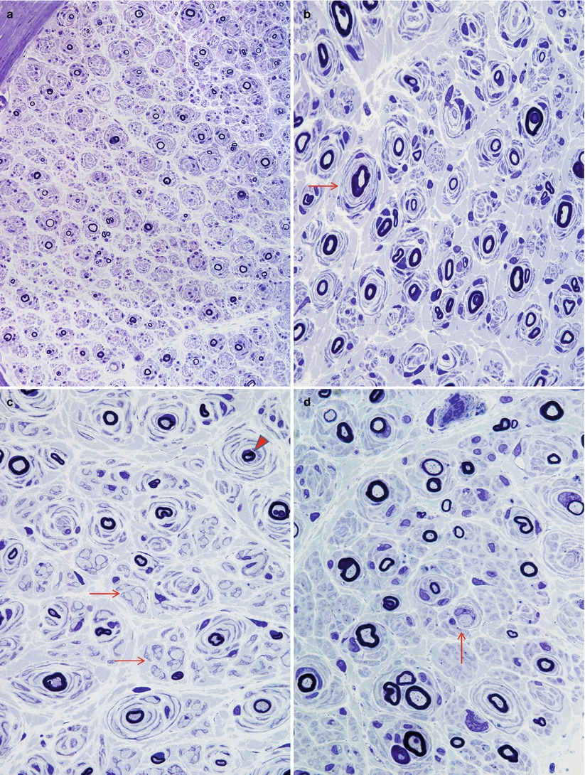Determined Neuropathies Neupsy Key