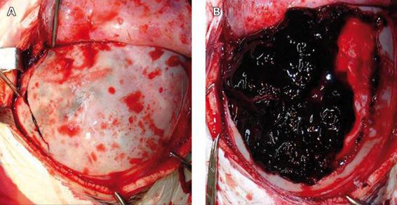 Surgical Management of Severe Traumatic Brain Injury