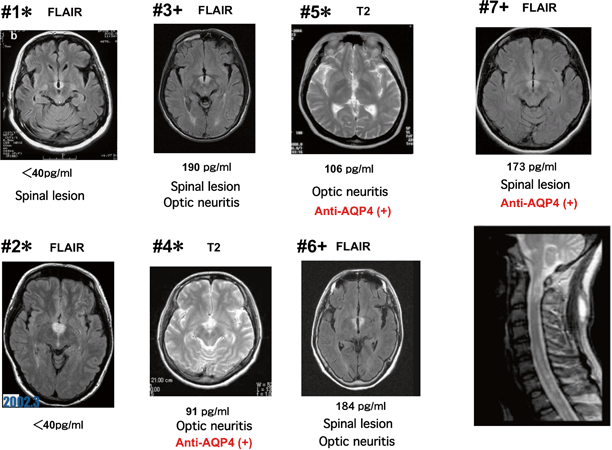 Narcolepsy Cataplexy Syndrome And Symptomatic Hypersomnia Neupsy Key