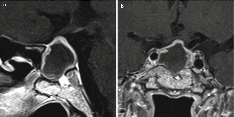 Rathke Cleft Cysts | Neupsy Key