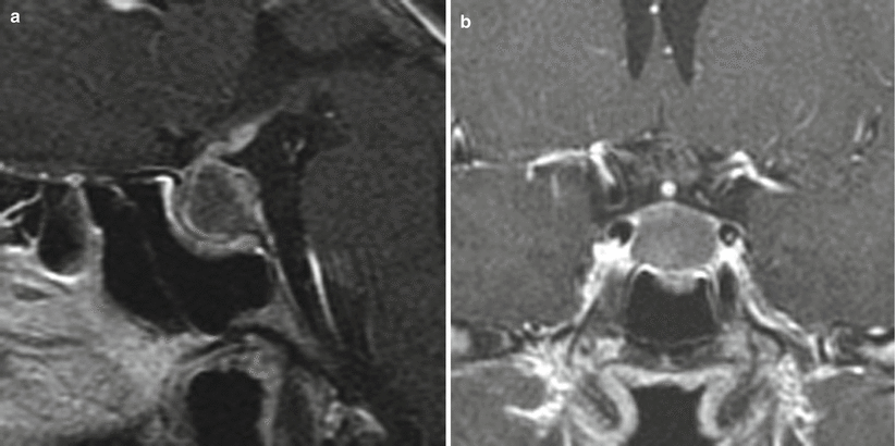 Rathke Cleft Cysts | Neupsy Key