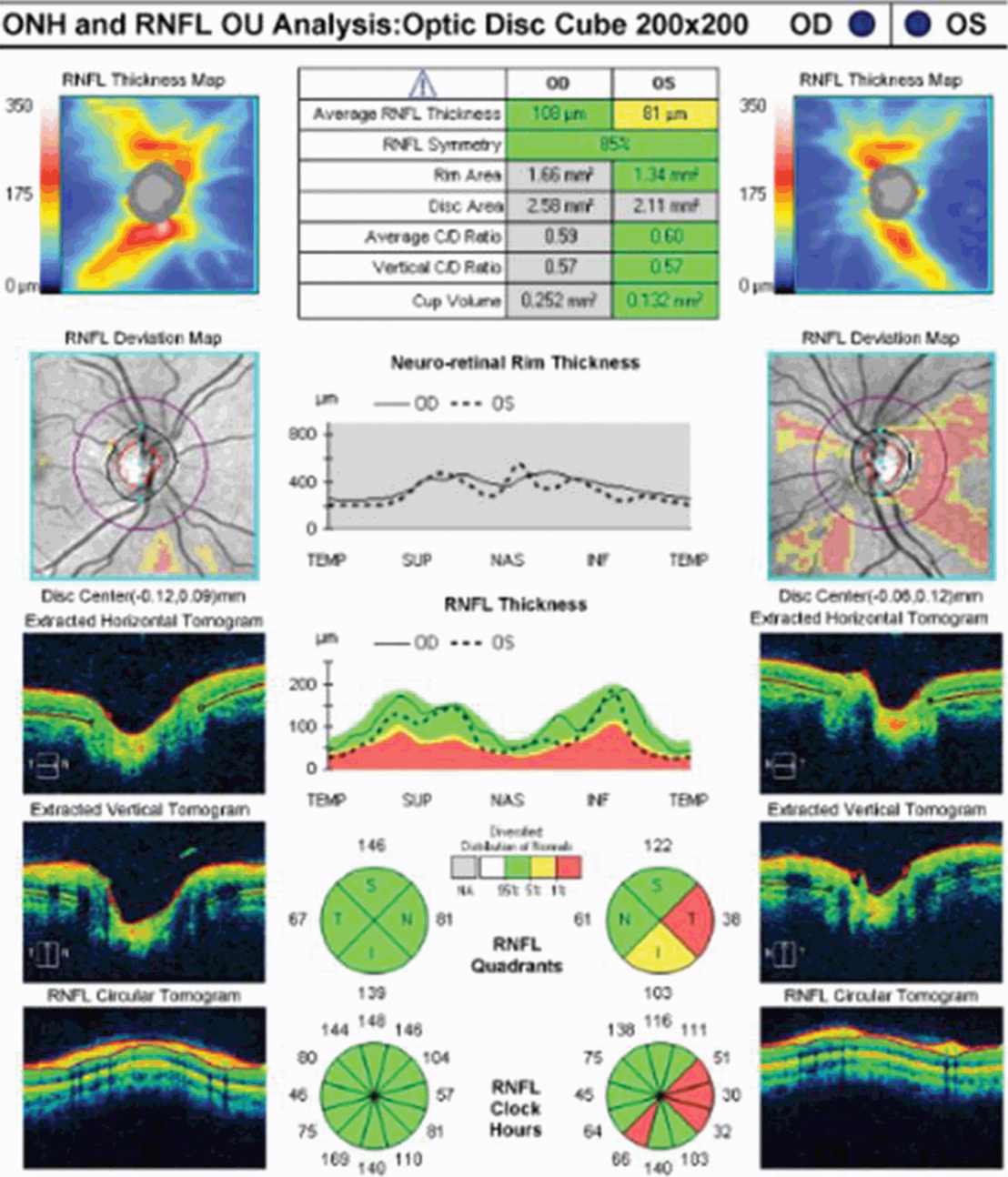 Optical coherence tomography and visual in acute optic
