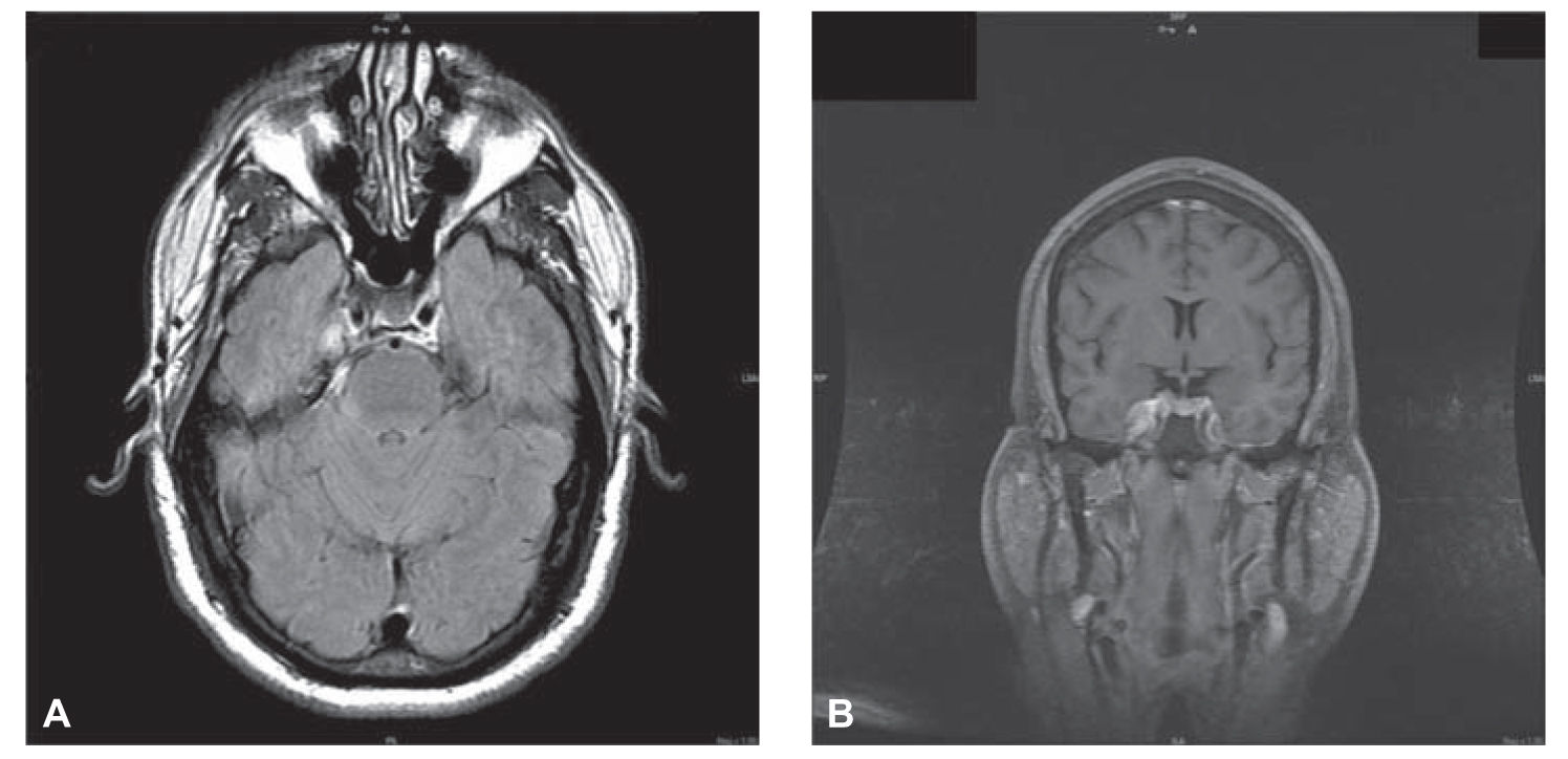 Approach to the Patient with Facial Numbness Neupsy Key