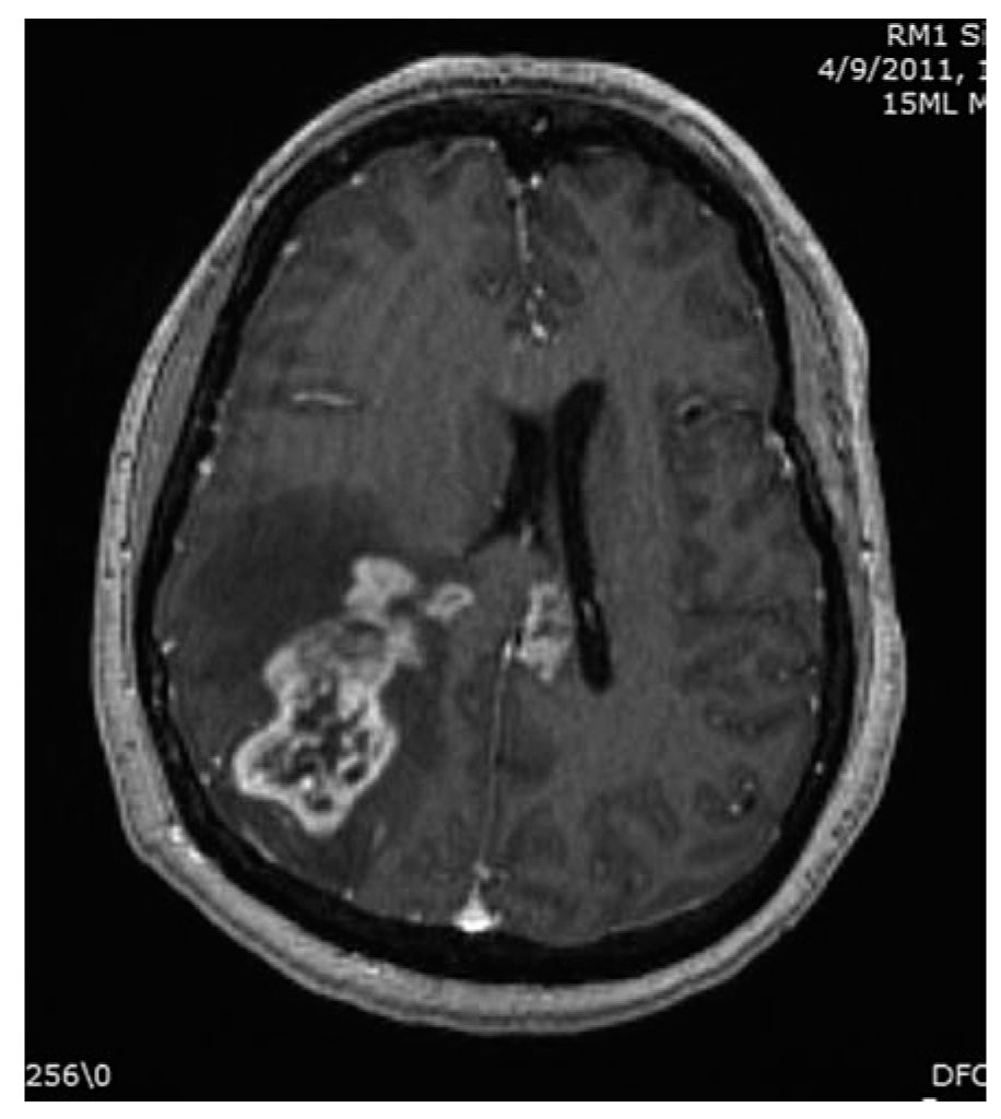 Primary Central Nervous System Tumors Neupsy Key