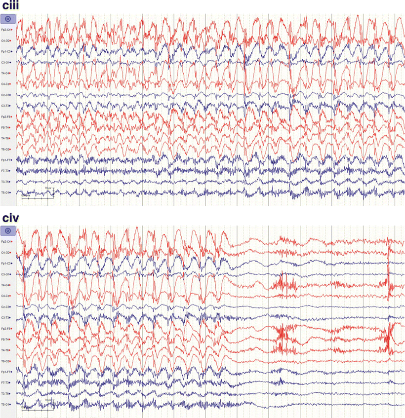Diagnosing and Monitoring Seizures in the ICU The Role of Continuous