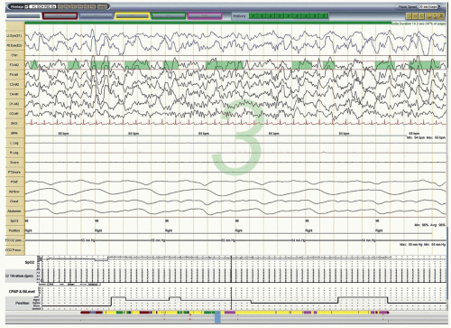 Introduction to Sleep and Polysomnography | Neupsy Key