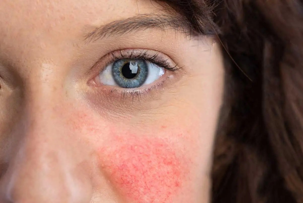 Understanding Why Facial Flushing Or Sweating Occurs