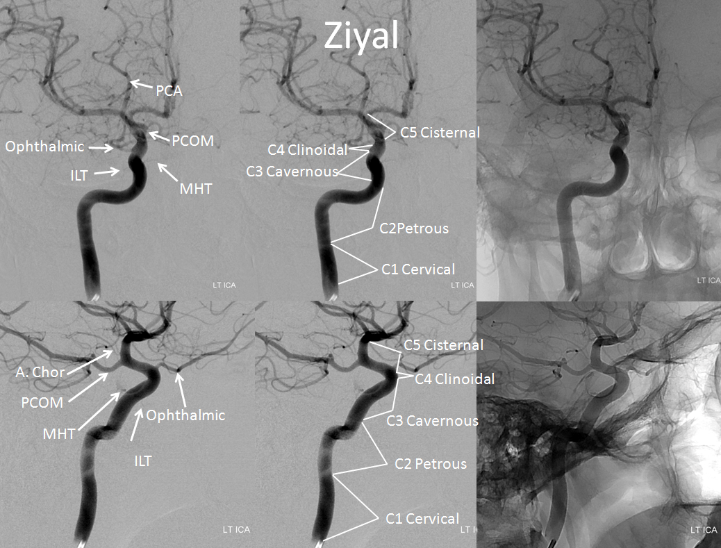 Internal Carotid Artery and Its Aneurysms
