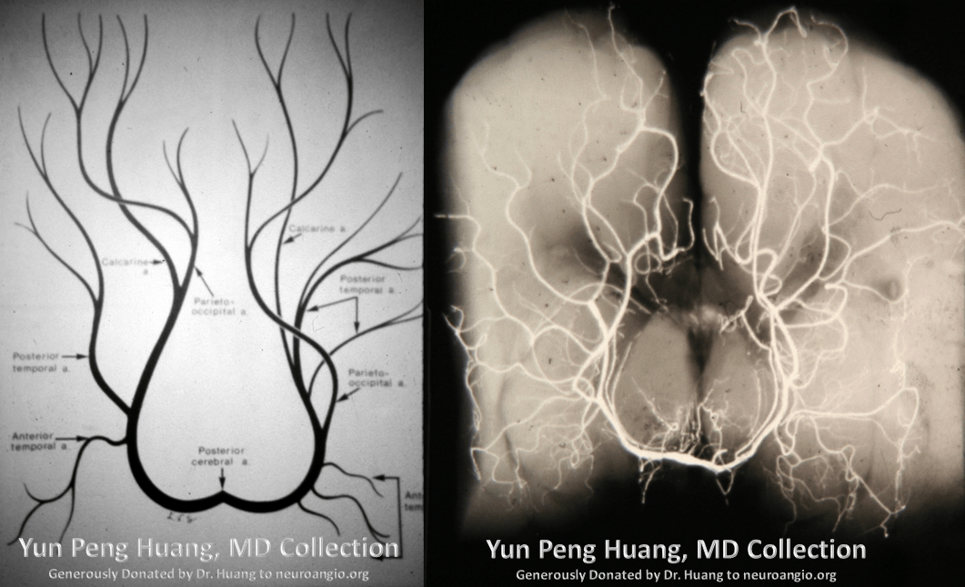 Posterior Cerebral Artery