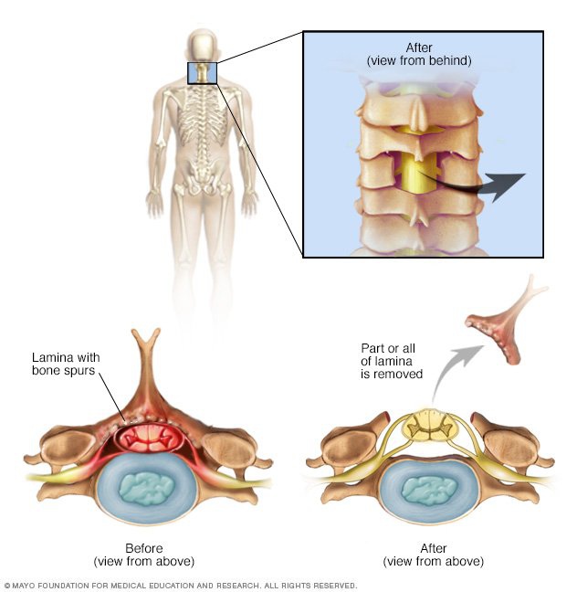 Laminectomy Procedure, Preparation and Recovery Neuroaxis