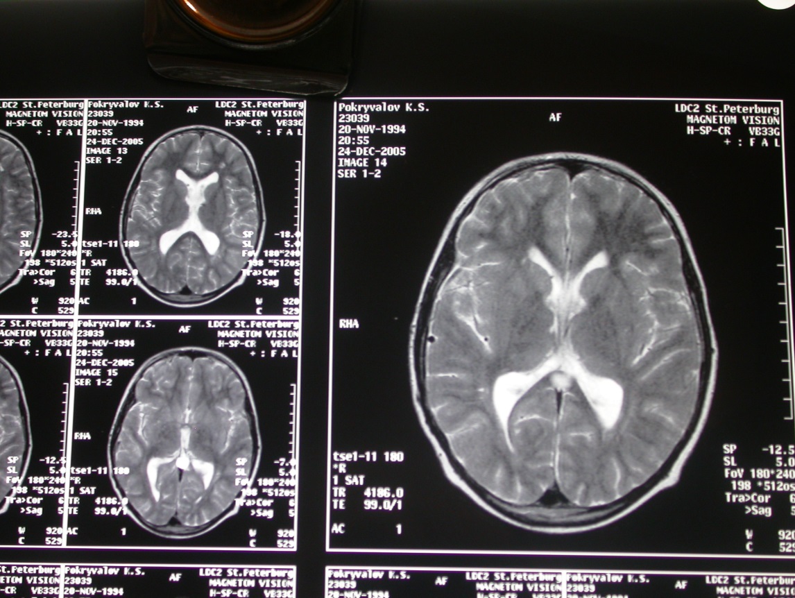 боковые желудочки большого мозга. развитие желудочковой системы головного мозга онтогенез. головной мозг сильвиев водопровод. боковые желудочки анатомия строение. головной мозг kenhub.