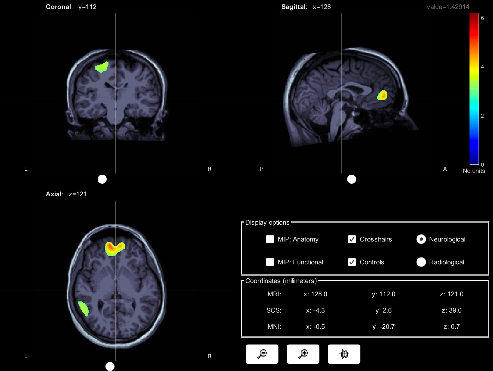 Error with import of subcortical SVReg from Brainsuite Bugs Brainstorm