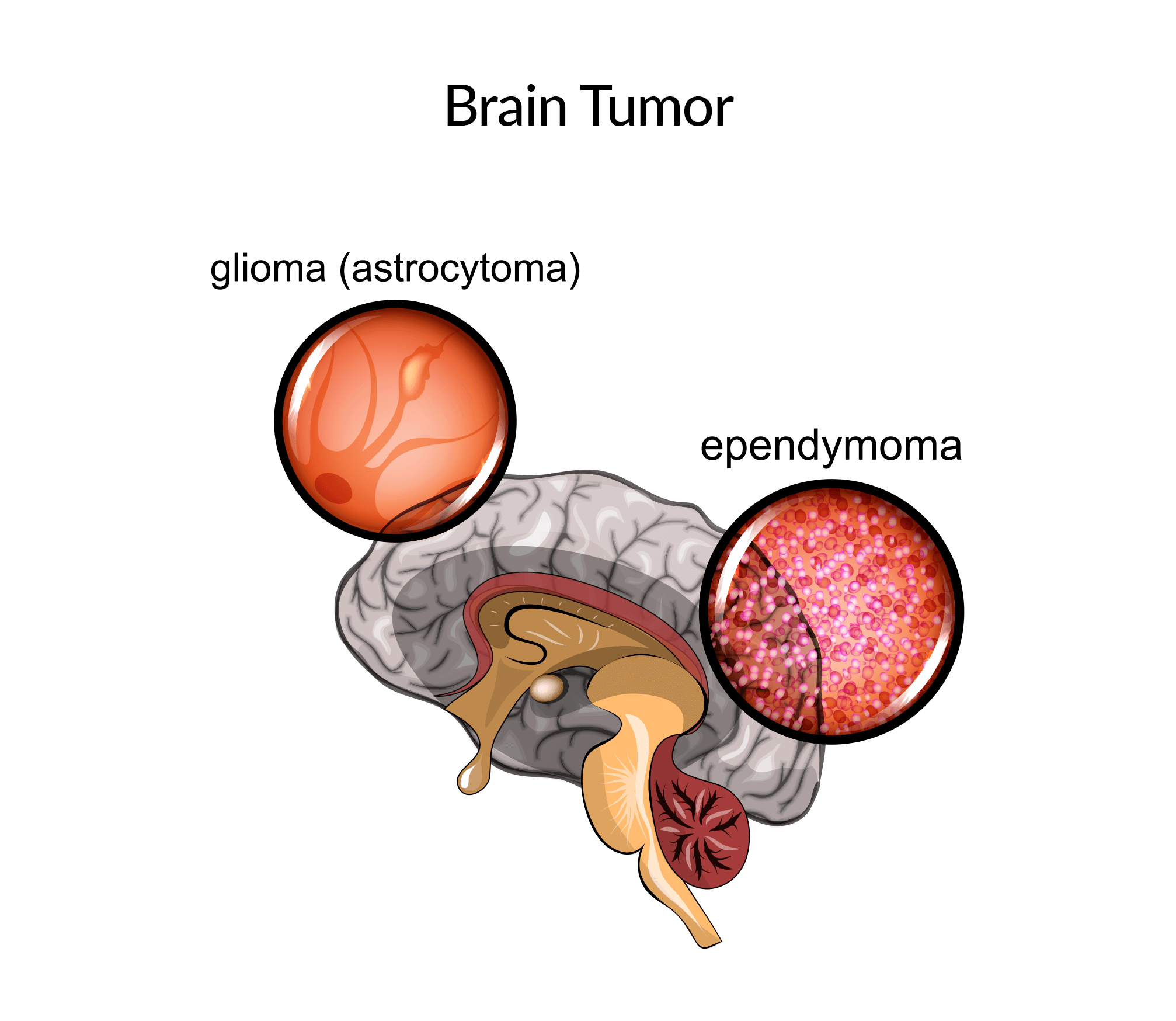 Brain Tumors Q & A Nkrumah Neurosurgery