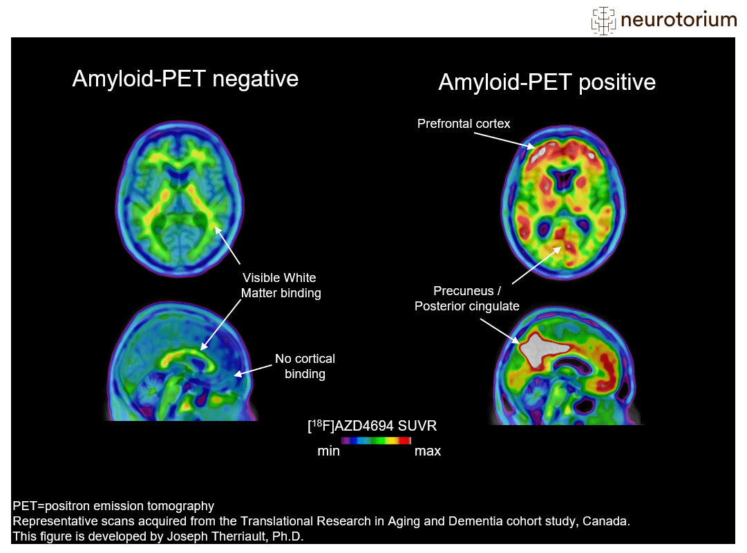 AmyloidPET imaging in Alzheimer's disease Neurotorium