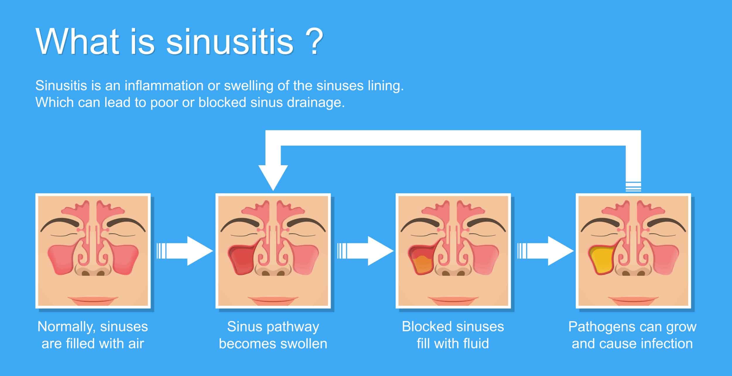 Sinusitis Treatment Las Vegas NV Sinus Infection