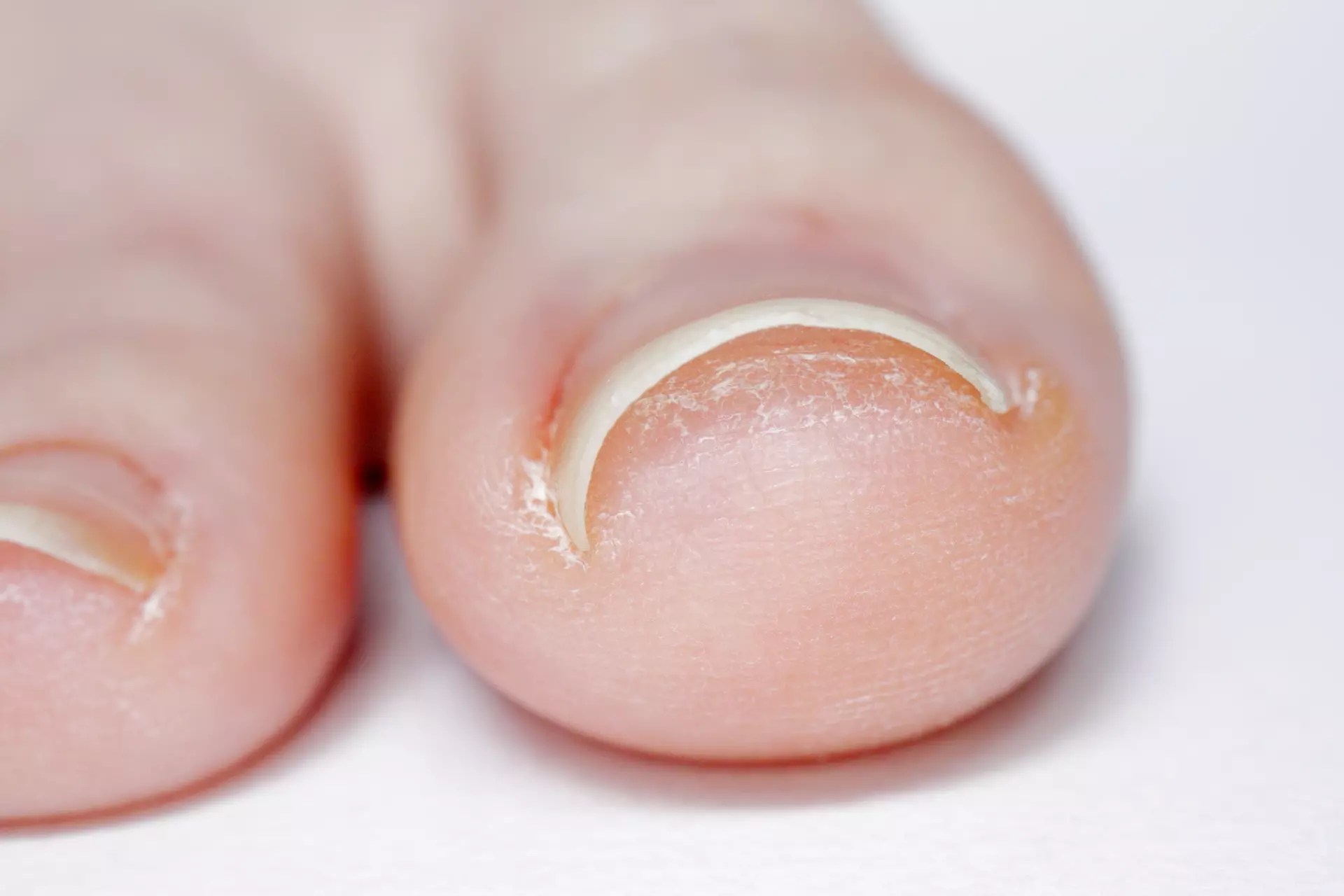 Ingrown Toenails in Burbank, Northridge & Santa Clarita Los Angeles