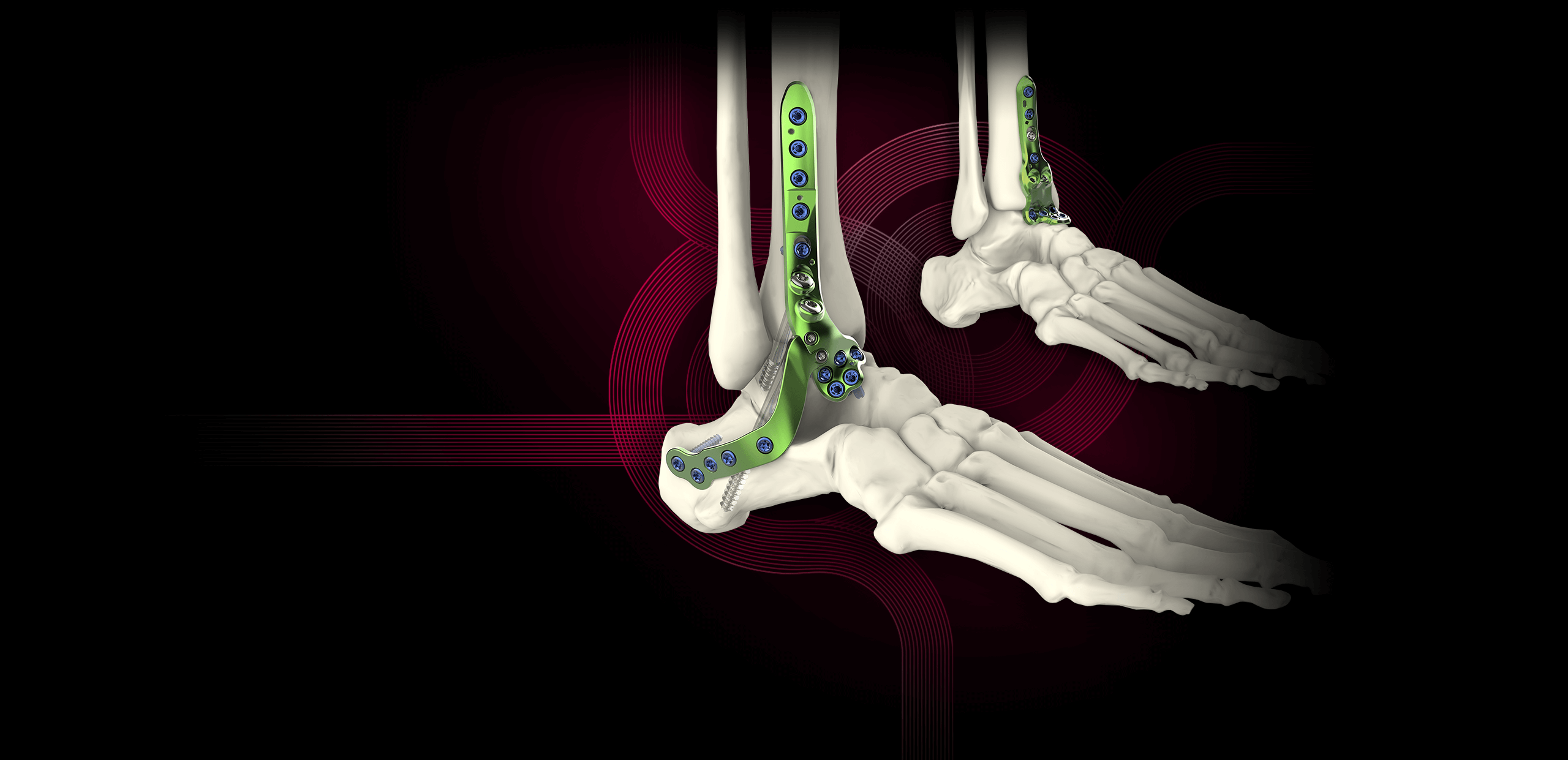 Activ Fuse ankle arthrodesis plates Newclip Technics