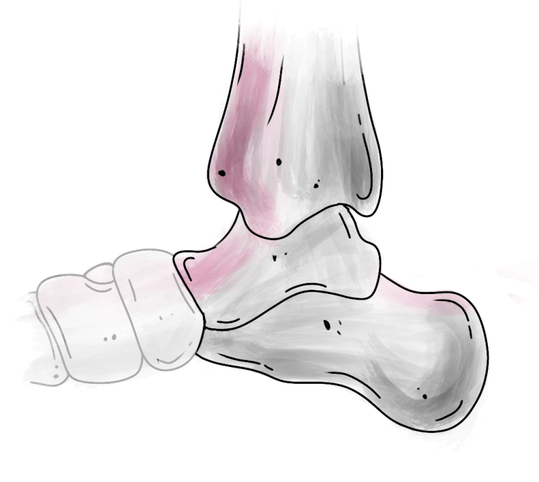 Activ Fuse ankle arthrodesis plates Newclip Technics