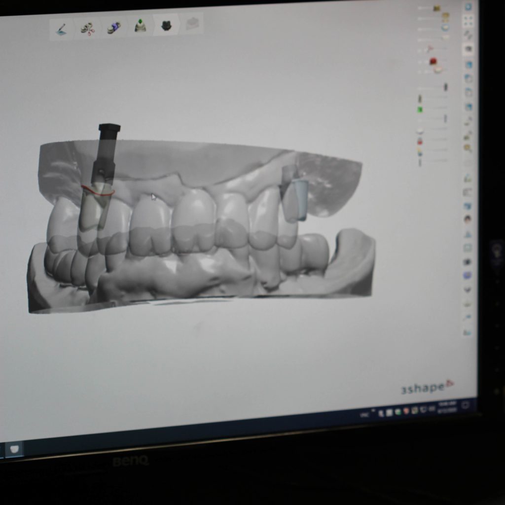 Implants New Image Dental Laboratory