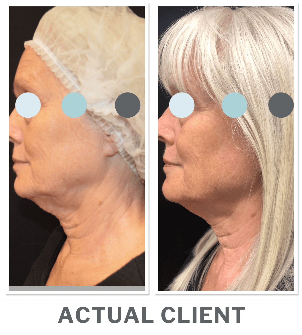 Ultherapy® New Image Med Spa