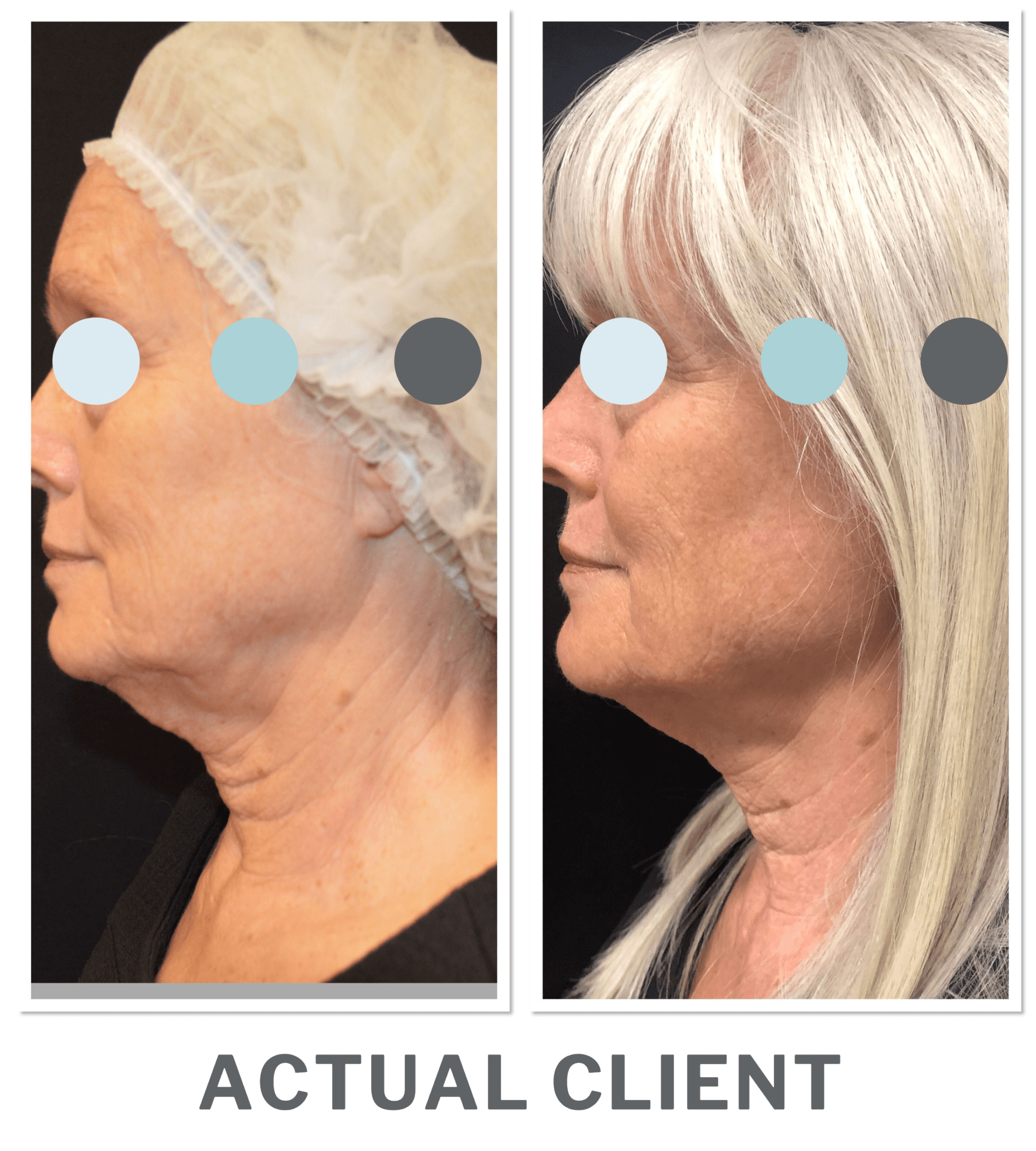 Ultherapy® New Image Med Spa