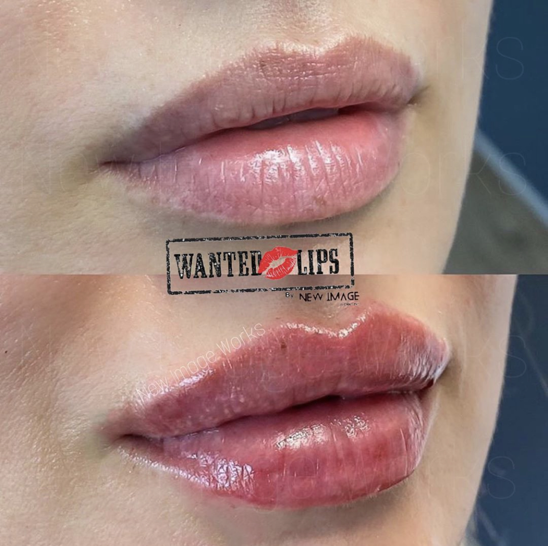Gloss And Go Lips Before After