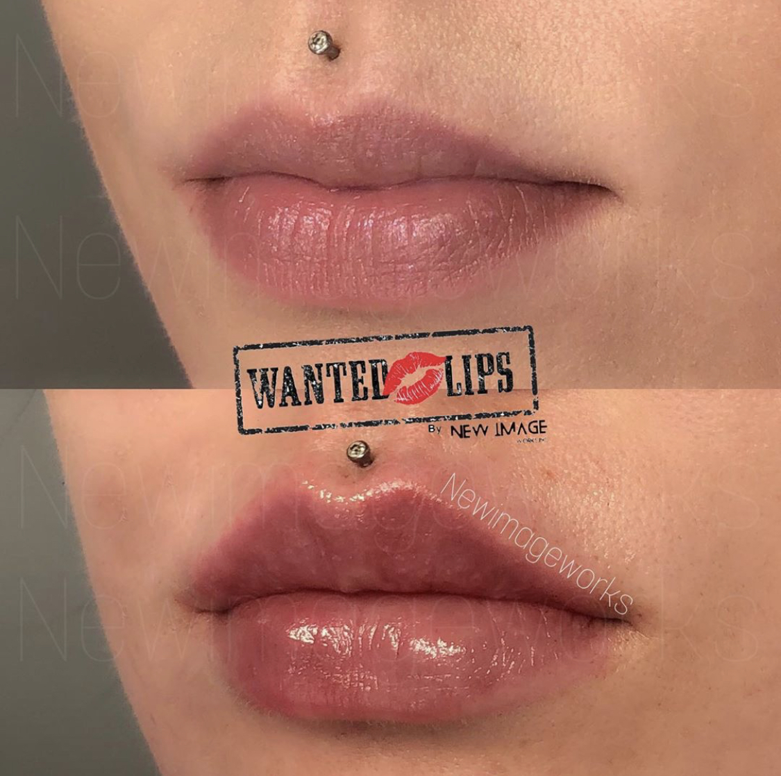 Wanted Lips Professional Treatments by a Leading Expert