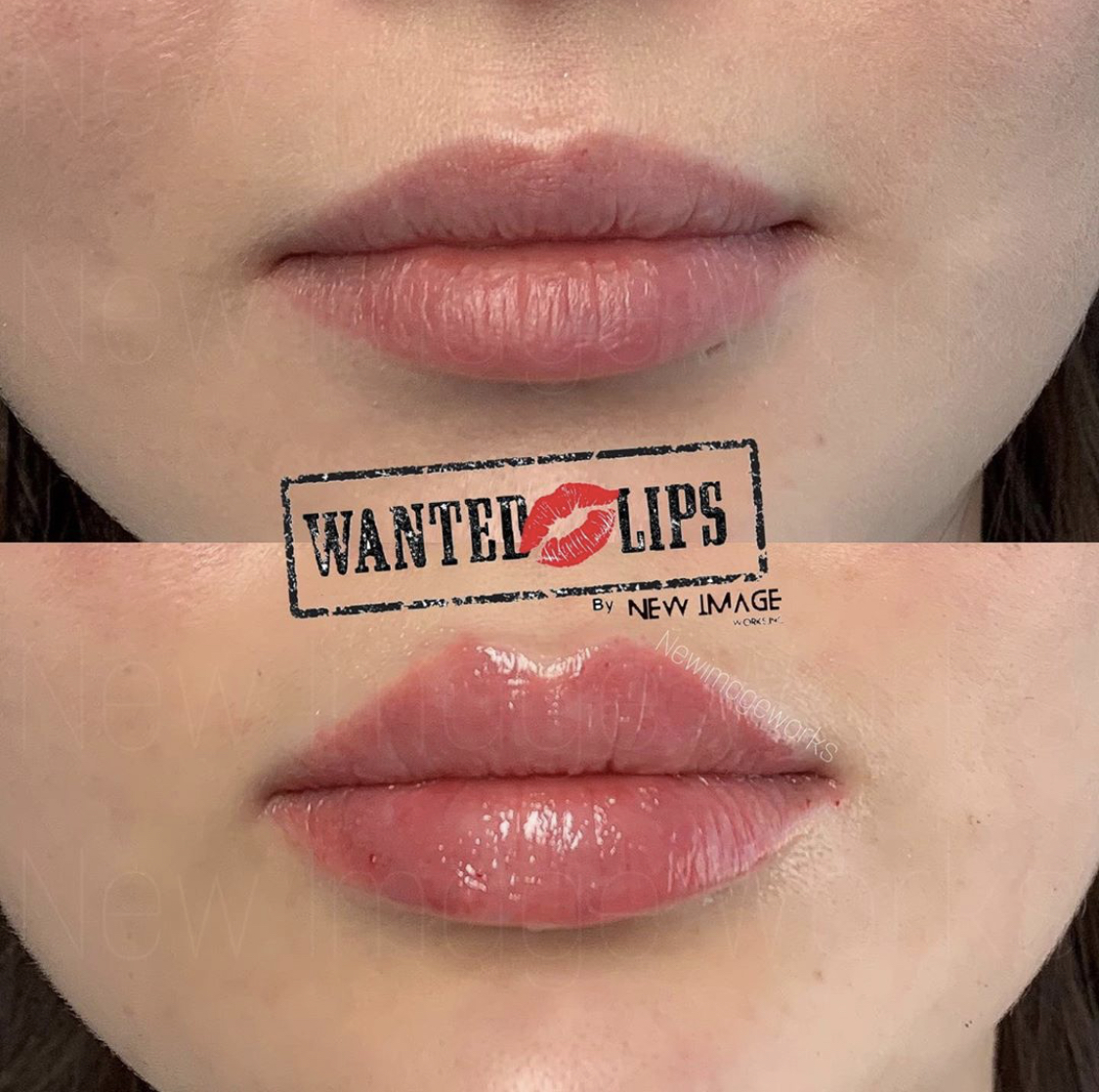 Wanted Lips Professional Treatments by a Leading Expert