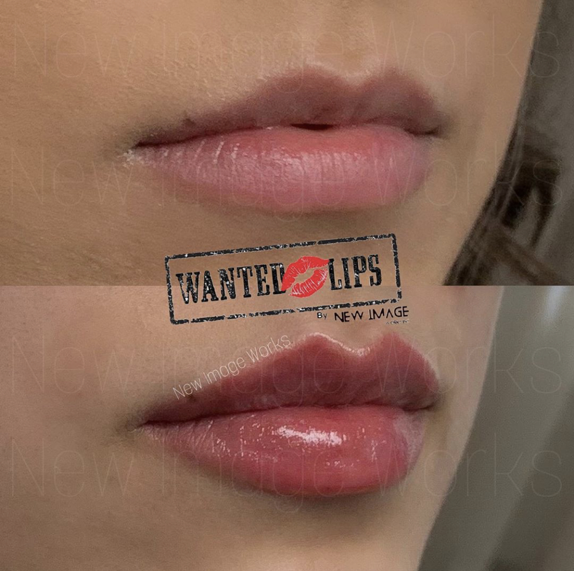 Wanted Lips Professional Treatments by a Leading Expert