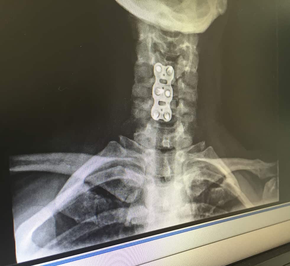 An Undreadful and Upbeat Story About Neck Surgery New Mobility
