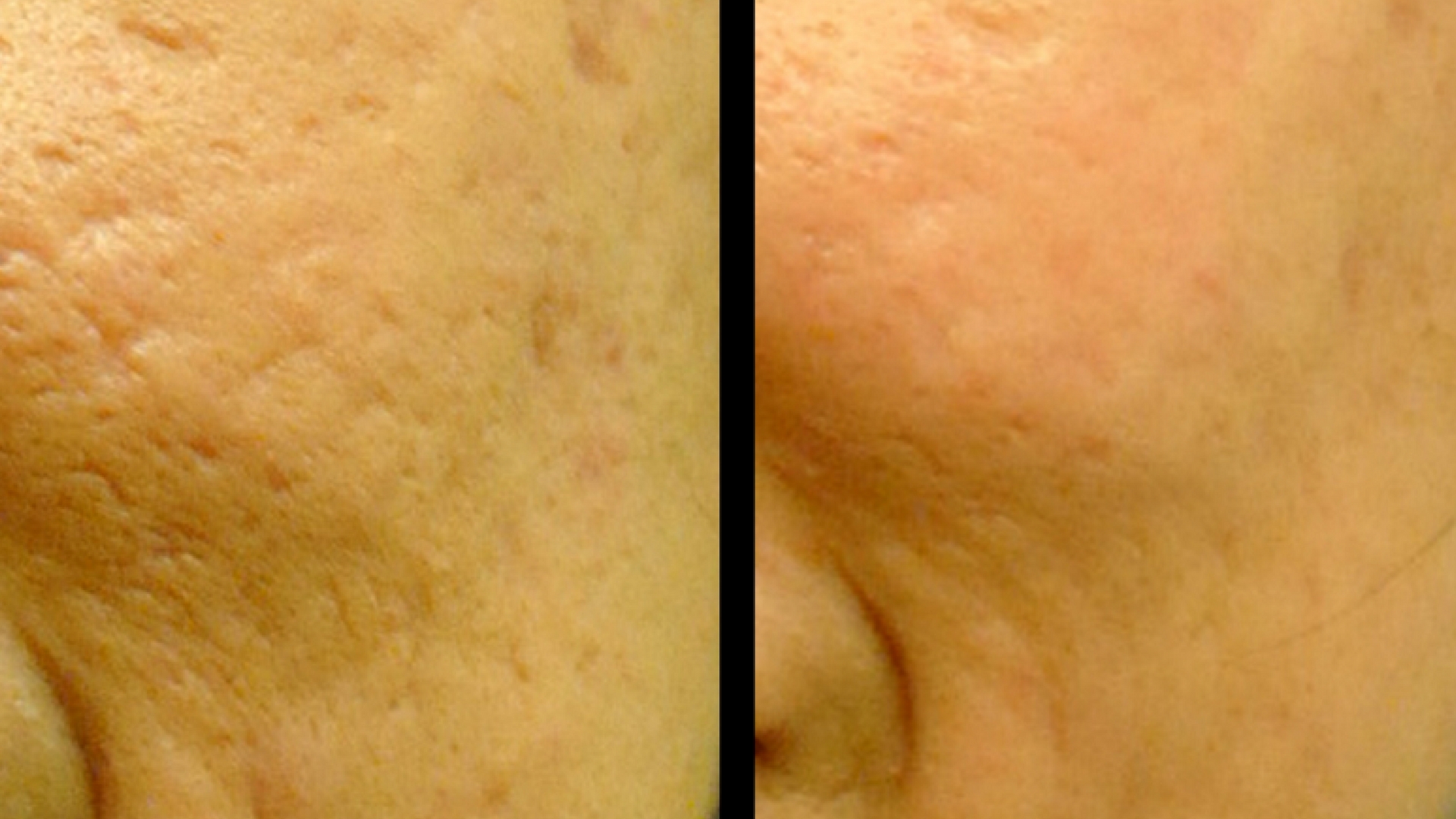 ICON 1540 / Laser Skin Resurfacing | Newport Aesthetics