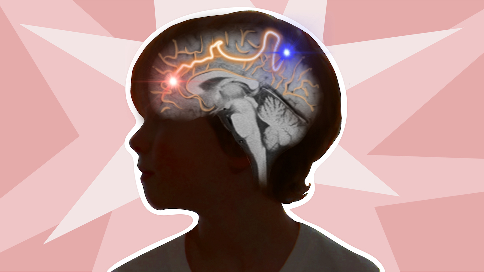 Understanding how pediatric epileptic spasms move through the brain
