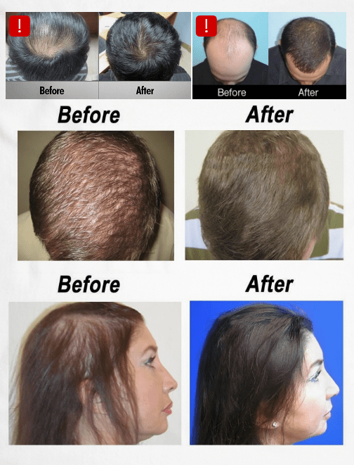NEW STRANDS Laser Hair Therapy New York Laser Therapy