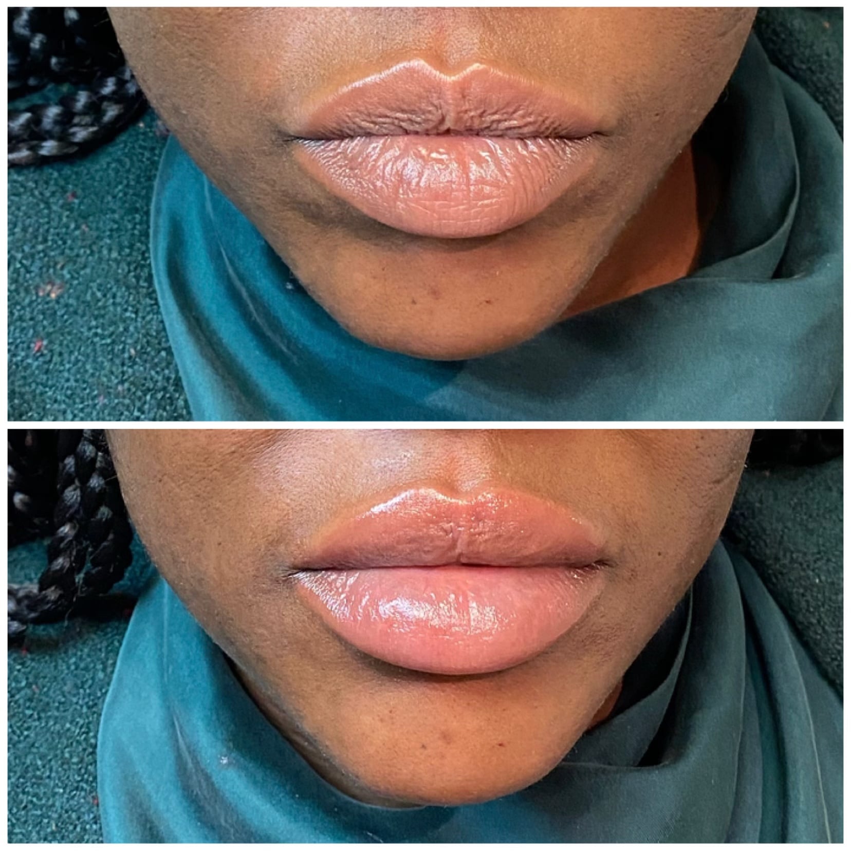 The Questions People Are Asking About Russian Doll Lips New You Spa