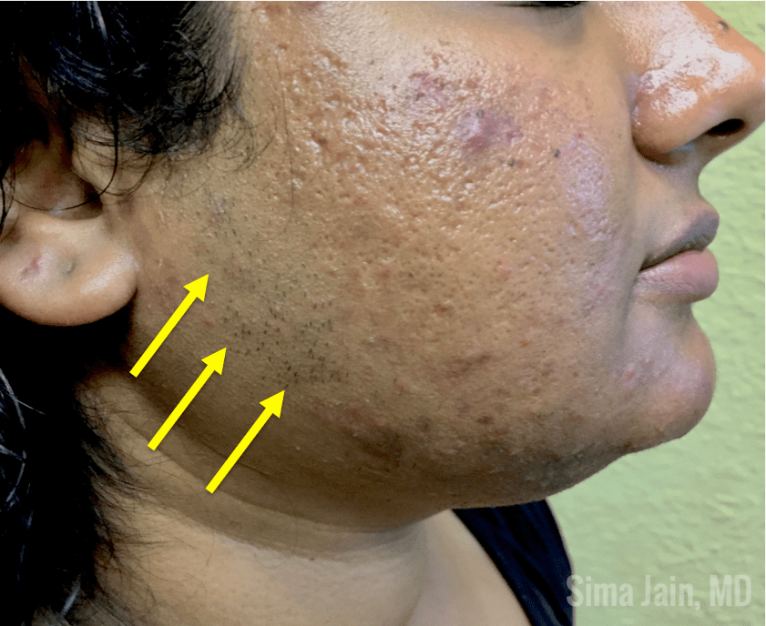 Part 1 Hormonal Acne Exam, Work Up, & Diagnosis Next Steps in