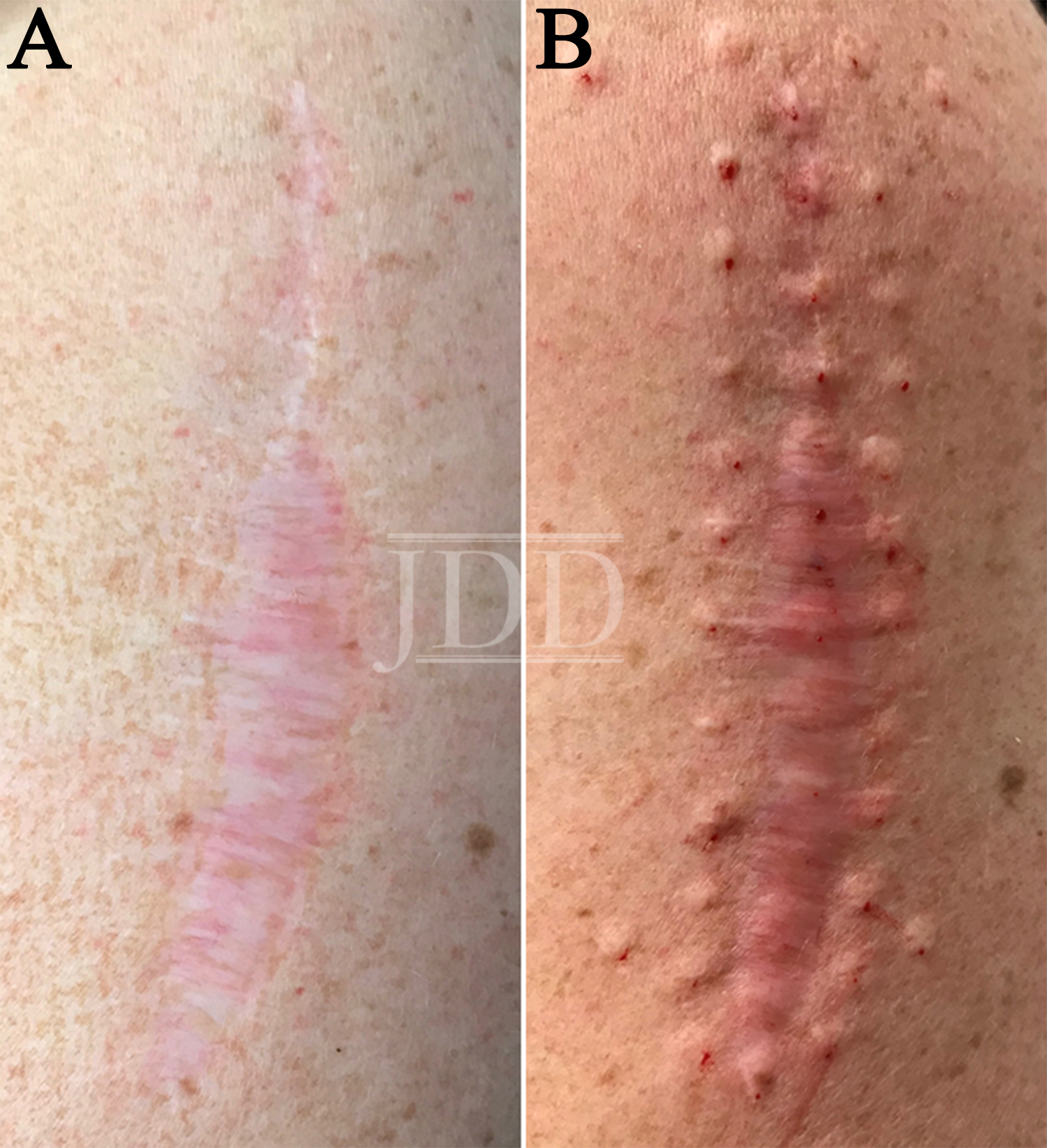 Battling Neuropathic Scar Pain With Botulinum Toxin Next Steps in Dermatology