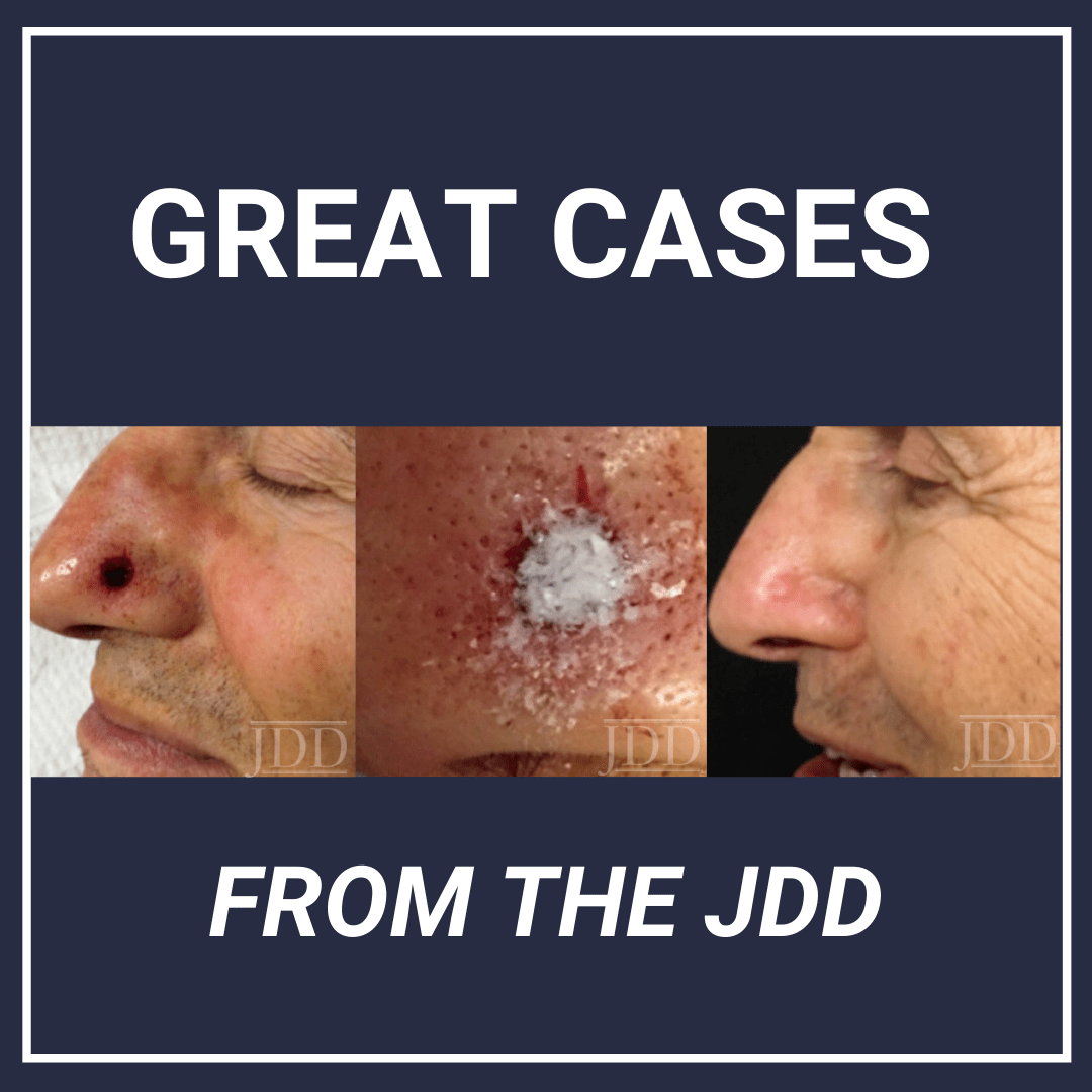 Methacrylate Polymer Powder Dressing for a Nasal Surgical Defect Next