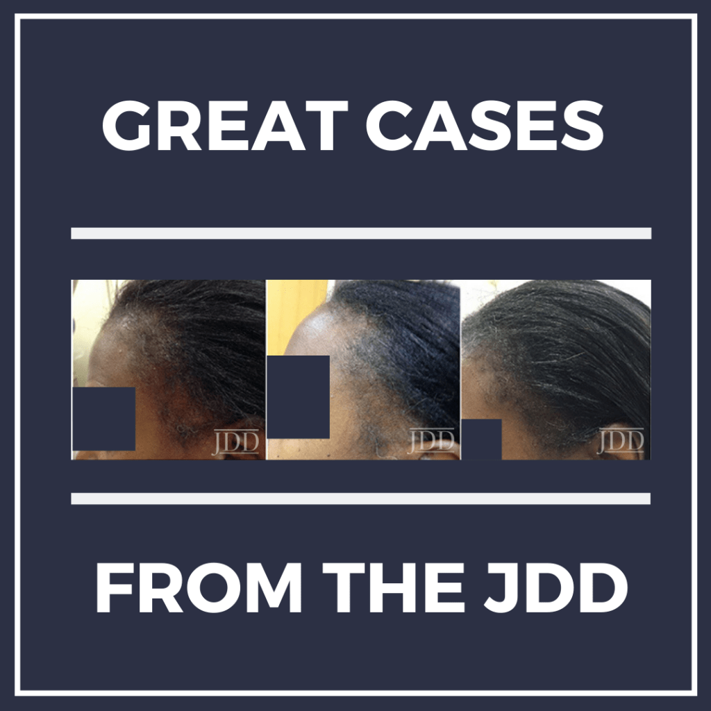 Intralesional Triamcinolone Acetonide in the Treatment of Traction Alopecia Next Steps in